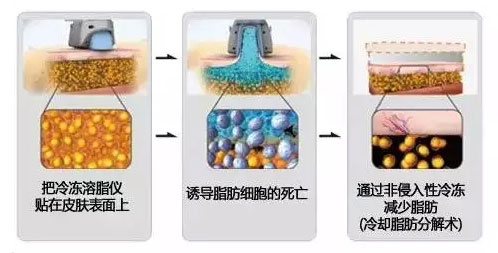 艺星酷塑冷冻溶脂原理解析