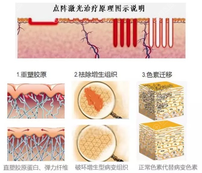 点阵激光祛除疤痕原理图