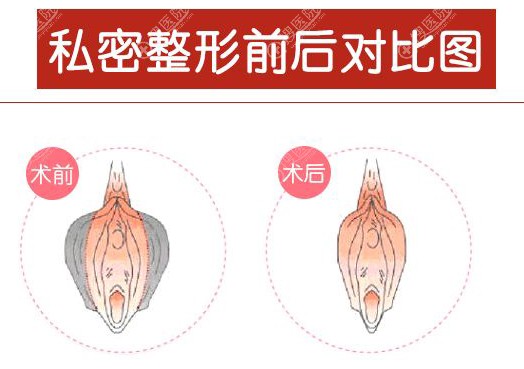 私密整形前后对比